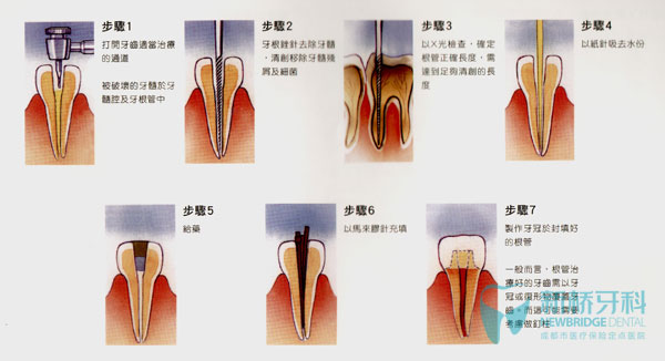 根管治疗基本步骤<图解>